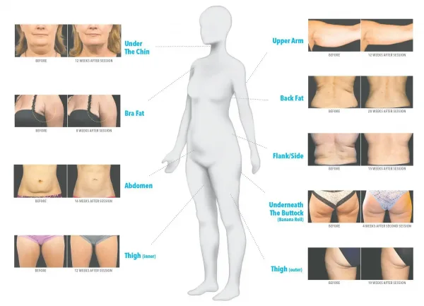 Coolsculpting Fat Freezing